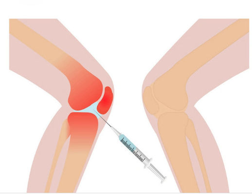 3 ml Mesotherapie-Lösung für Knieschmerzen, nicht vernetzte Hyaluronsäure
