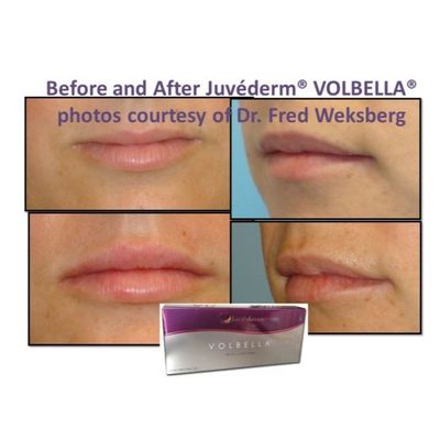 Hyaluronsäure Juvederm Gesichtsfiller Gel Glatte und makellose Haut