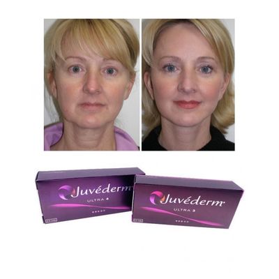 6-9 Monate Dauer Juvederm Dermal Filler Gel zum Online- und im Ladenkauf