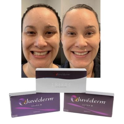 Juvederm Dermale Lippenfüllstoffe Hyaluronsäure Kreuzverknüpfte Injektion