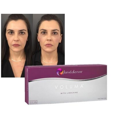 Hyaluronsäure Dermal Filler Gel Juvederm Lippen Wangen Verjüngung Verstärkung Formel