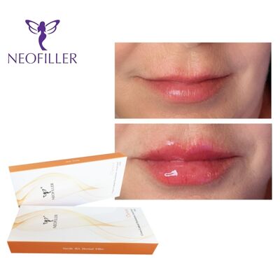 CE-zertifizierter, vernetzter Hyaluronsäure-Hautfüller, 24 mg/ml, injizierbares Gel, Lippenvergrößerung, Gesichtsverjüngung