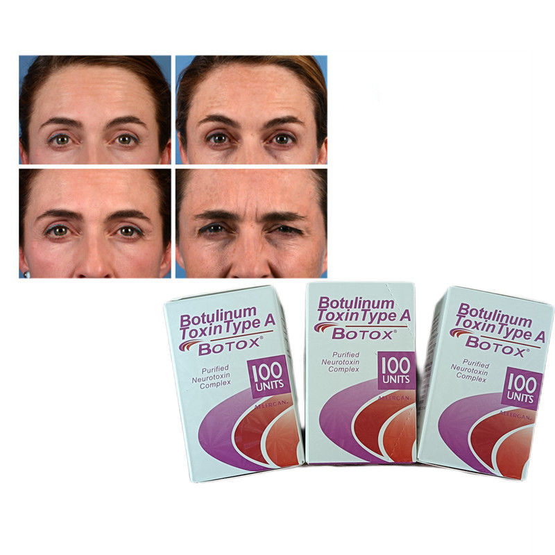100U/Flasche Botulinumtoxin Typ A pulver gegen Falten