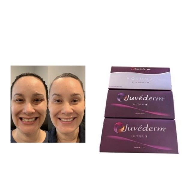 Verknüpfte HA Juvederm Hautfüllmittel Ultra3 Ultra4 Volumen Aufbewahrungsbedingungen Einfrieren vermeiden Injektionsgel zur Volumenwiederherstellung des Gesichts