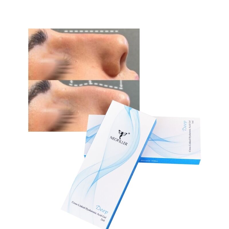 Kreuzverknüpfte 2 ml Hyaluronsäure Hautfüllmittel Tiefe Linie Nasenkontur Injektionsgel Gesichtsvergrößerung