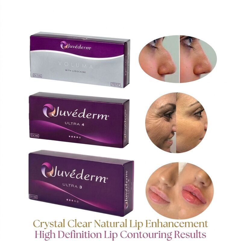 Volumen der Spritze 2 1 ml pro Schachtel Juvederm Volumen Füllstoff Sicherheit Gesichtskontur Injektierbarer Hautfüllstoff zur Volumenvergrößerung